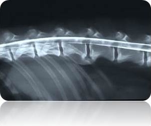 Normal Myelogram